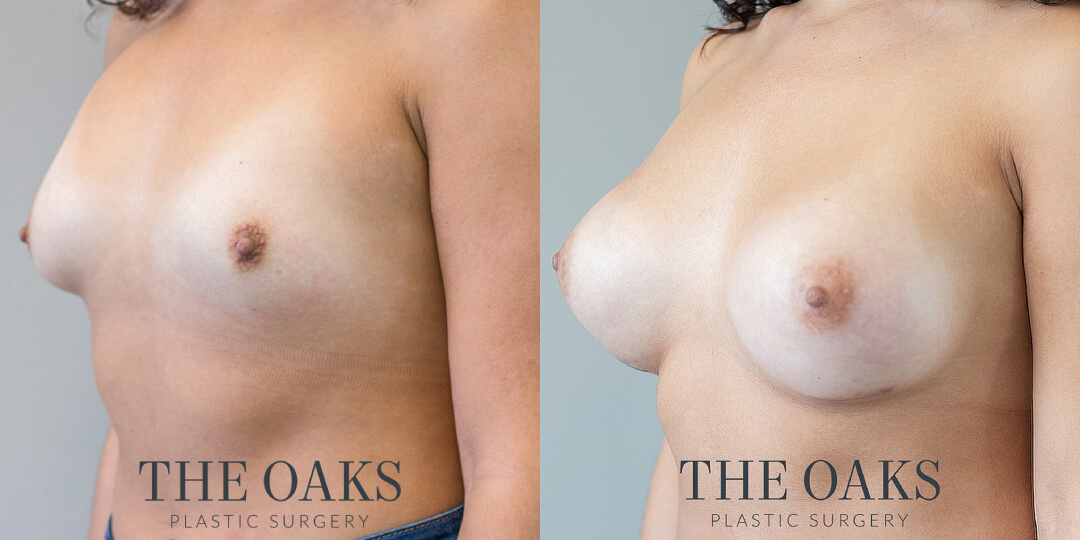 houston breast augmentation before and after