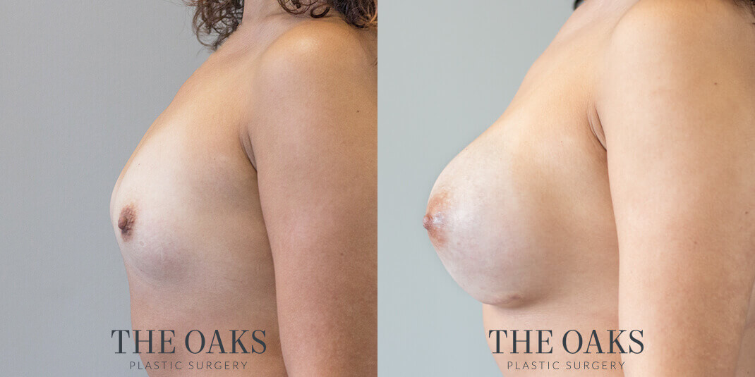 houston breast augmentation before and after