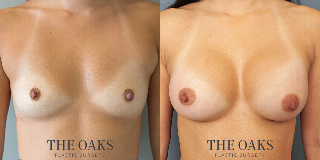 houston breast augmentation before & after 