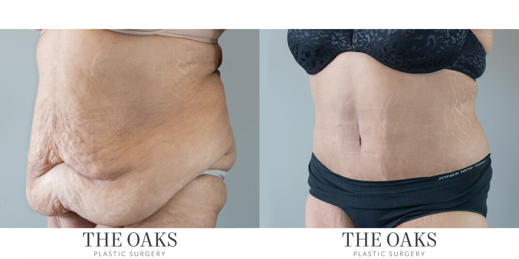 Houston Tummy Tuck Before & After | TOPS #6