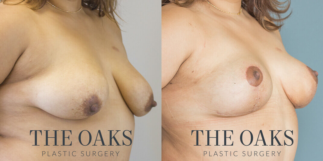 Breast Lift Houston Before & After | TOPS