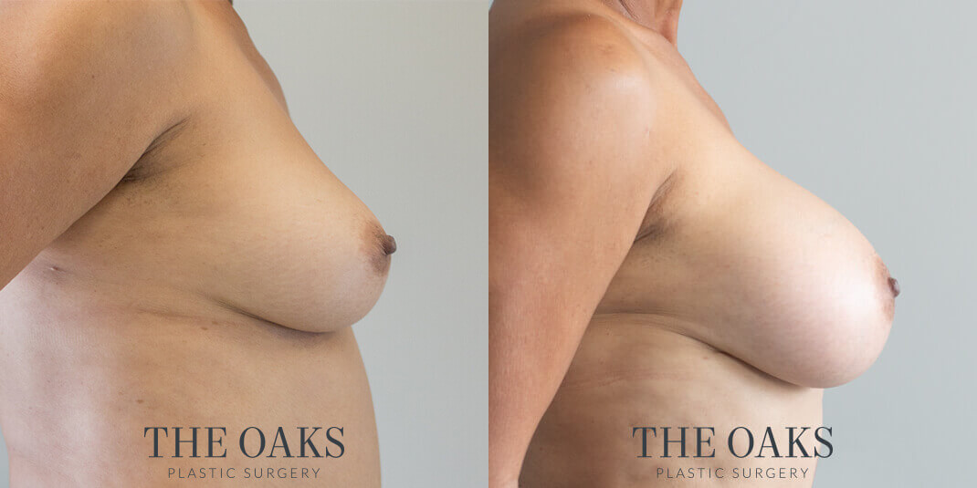 breast augmentation houston before & after