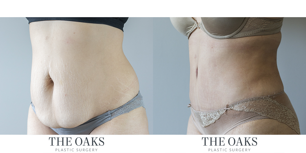 Houston Tummy Tuck Before & After The Oaks Plastic Surgery | TOPS #1