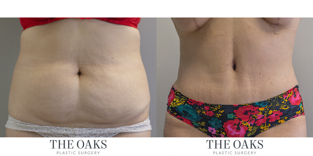 Tummy Tuck Houston Before & After
