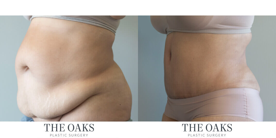 Houston Tummy Tuck Before & After | TOPS #1