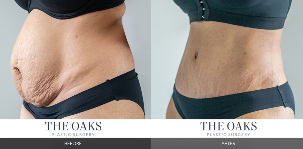 Liposuction Creates A Waist For Tummy Tuck Patients Case #206