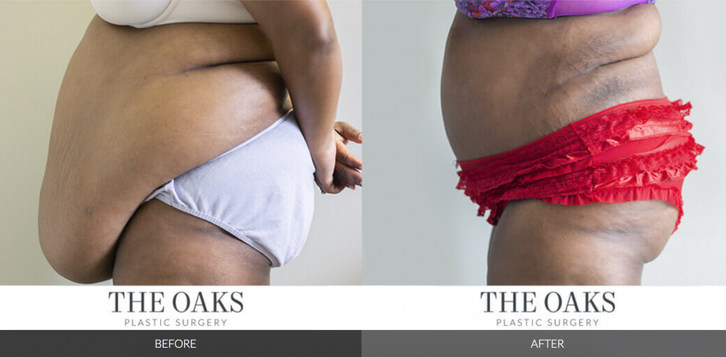 Tummy Tuck Cosmetic Surgery, Fat Loss Procedure, Liposuction, Removal  Excess Fat