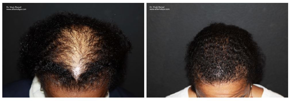 Houston Hair Transplant | Houston Hair Restoration | TOPS