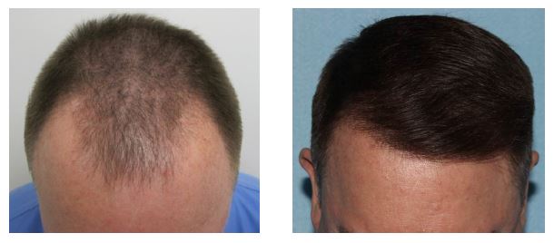 Houston Hair Transplant | Houston Hair Restoration | TOPS