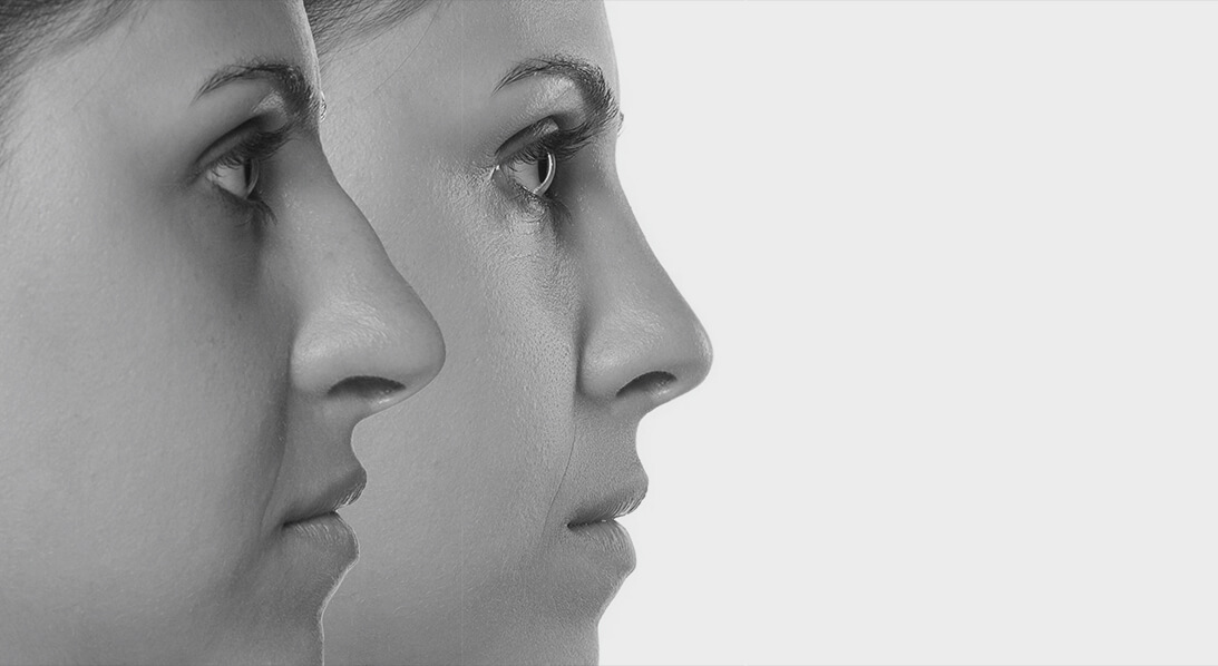 faces in profile nose surgery houston