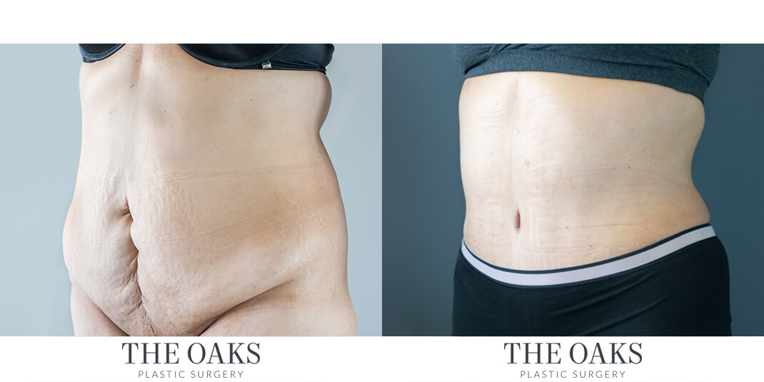 tummy tuck before and after houston