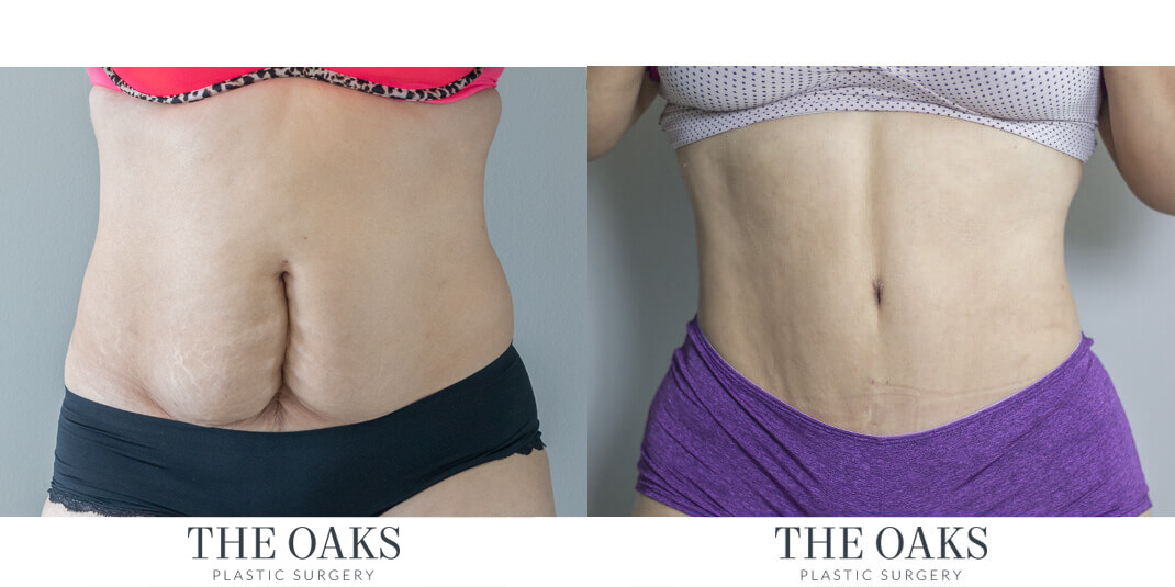 houston lipo before & after