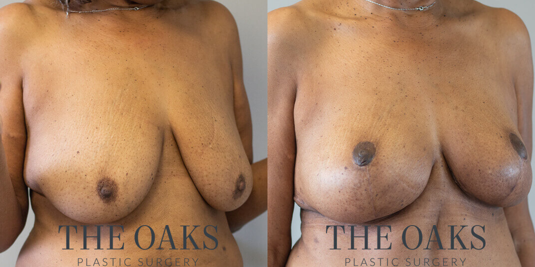Breast Lift Houston Before & After | TOPS