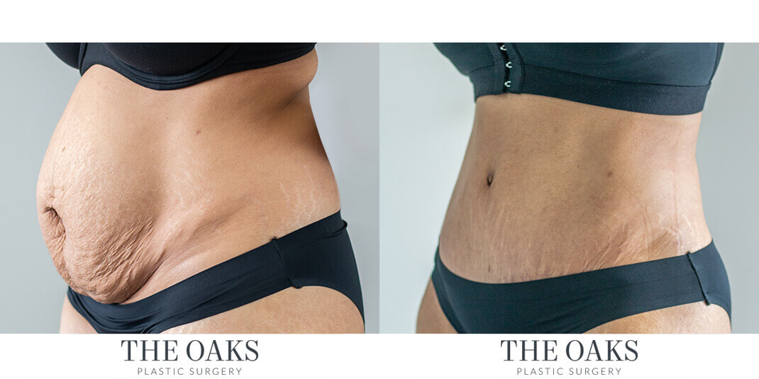 Houston Tummy Tuck Surgeons, Abdominoplasty Houston