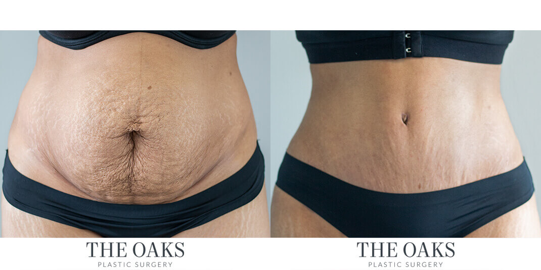 houston tummy tuck before & after