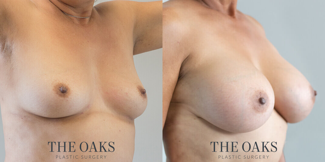 breast augmentation houston before & after