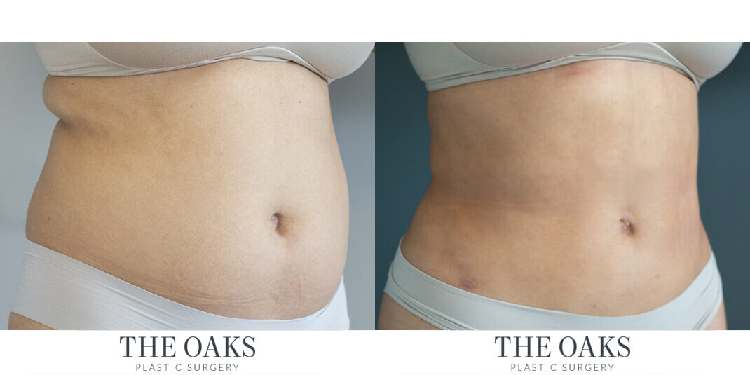 Houston Liposuction Before & After | TOPS #1