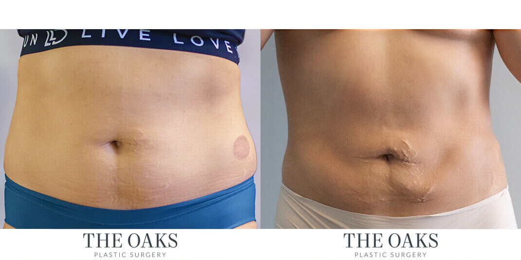 Houston Liposuction Before & After | TOPS #1