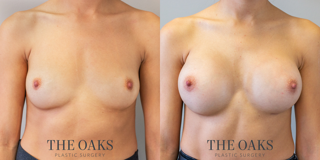 houston breast augmentation before & after 