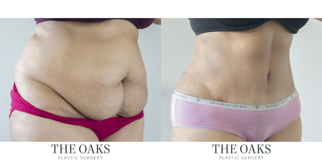 Tummy Tuck Houston Before & After | TOPS #1
