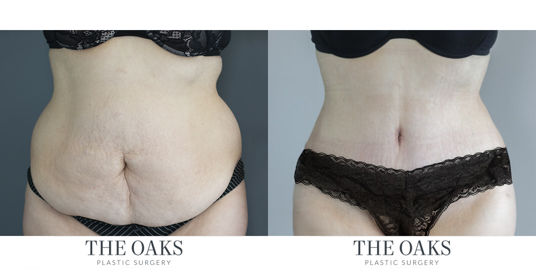 Houston Tummy Tuck Before & After | TOPS #6