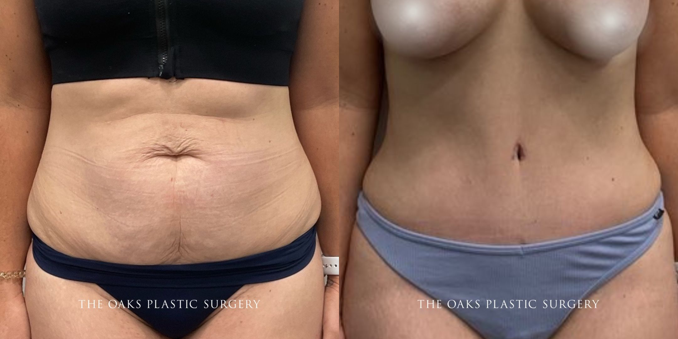 Houston Tummy Tuck Before & After | TOPS #1