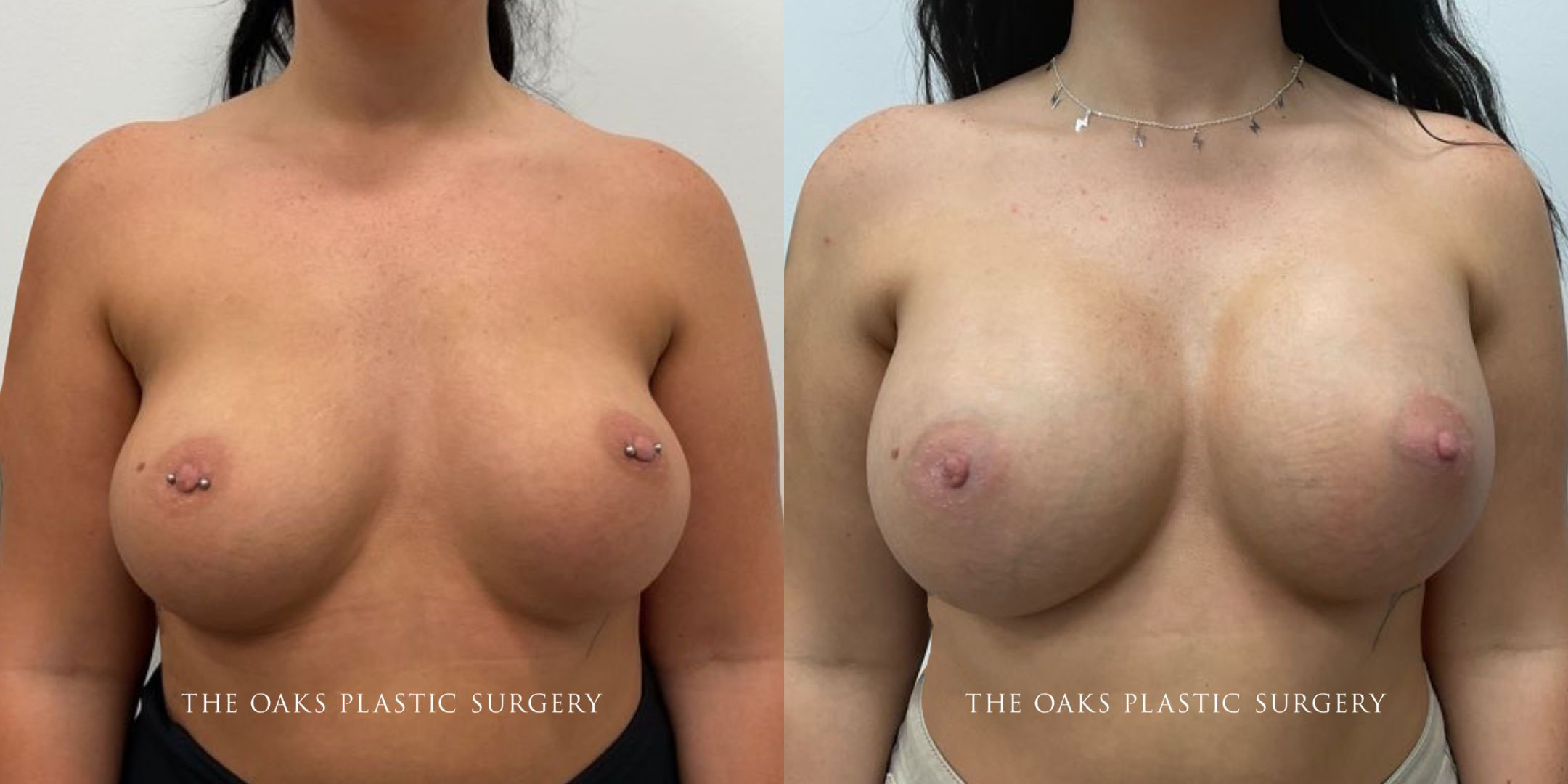 Breast implant exchange 1