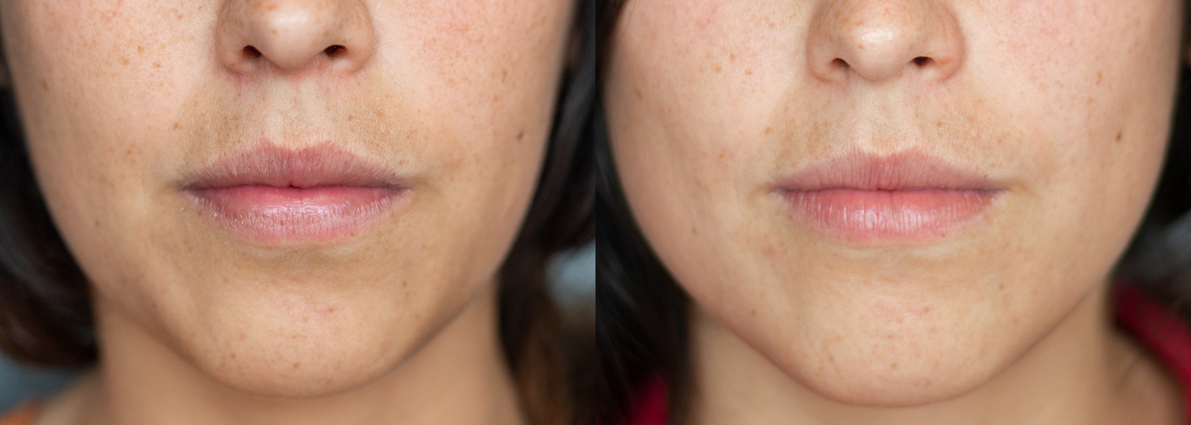 Houston Jawline Botox Injections