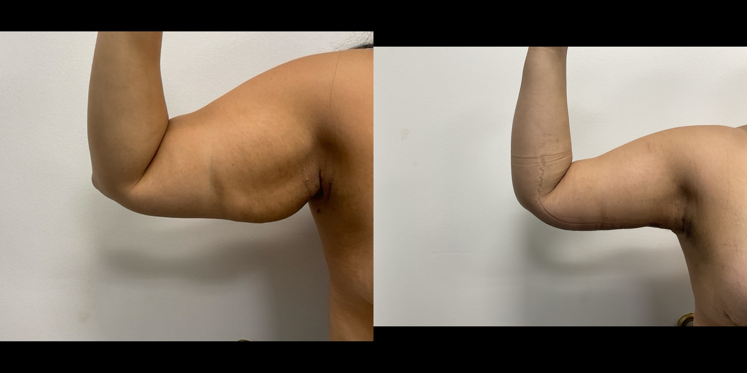 Arm Lift