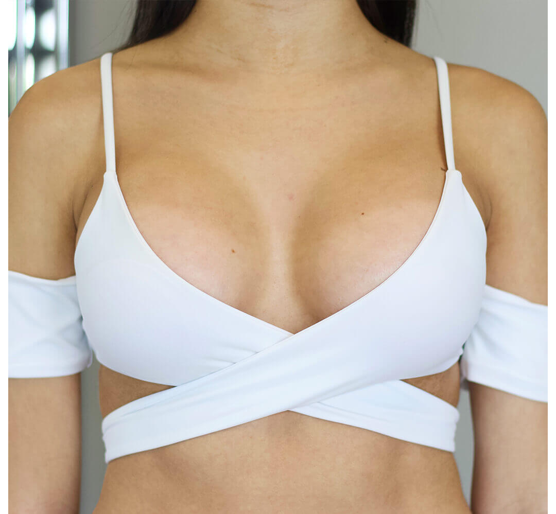 Breast Augmentation Houston After | Dr. Wijay