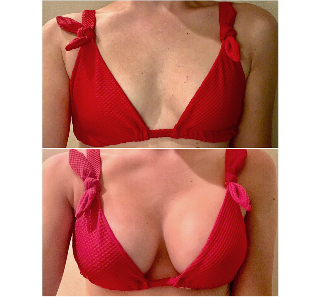Breast Augmentation Houston After | Dr. Wijay