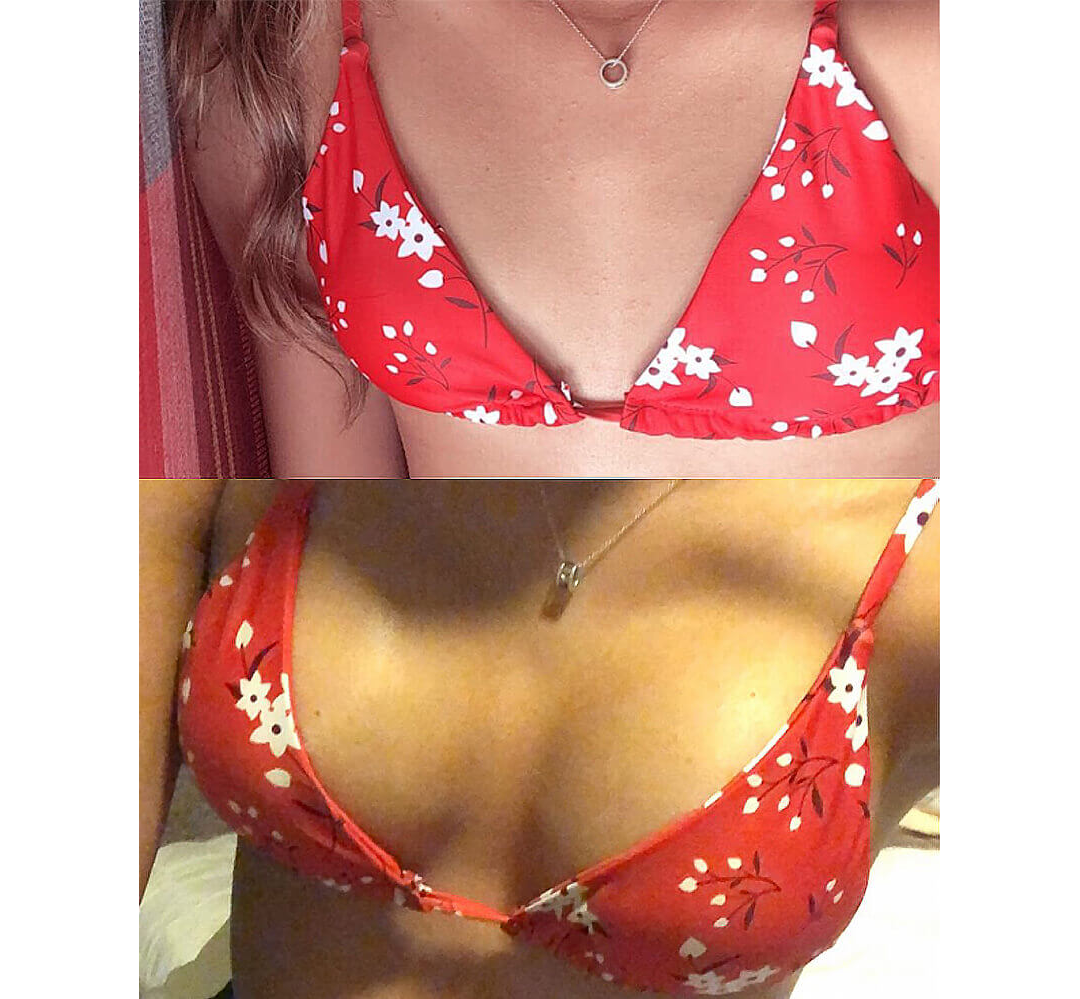 Breast Augmentation Houston Before & After | Dr. Wijay