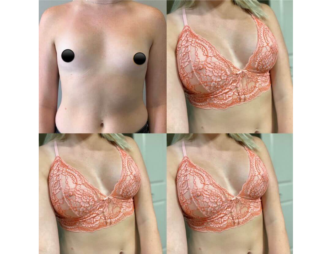 Breast Augmentation Houston After | Dr. Wijay